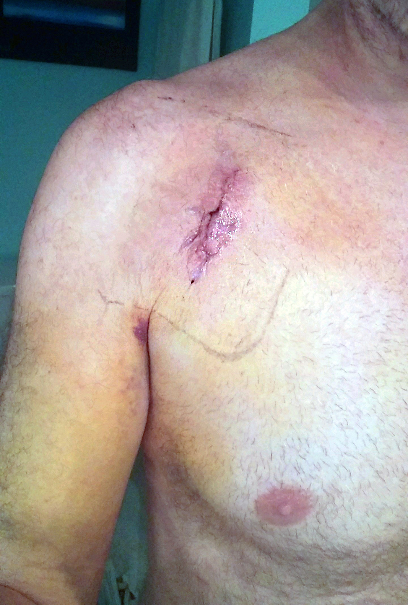 ICD surgery scar day 6